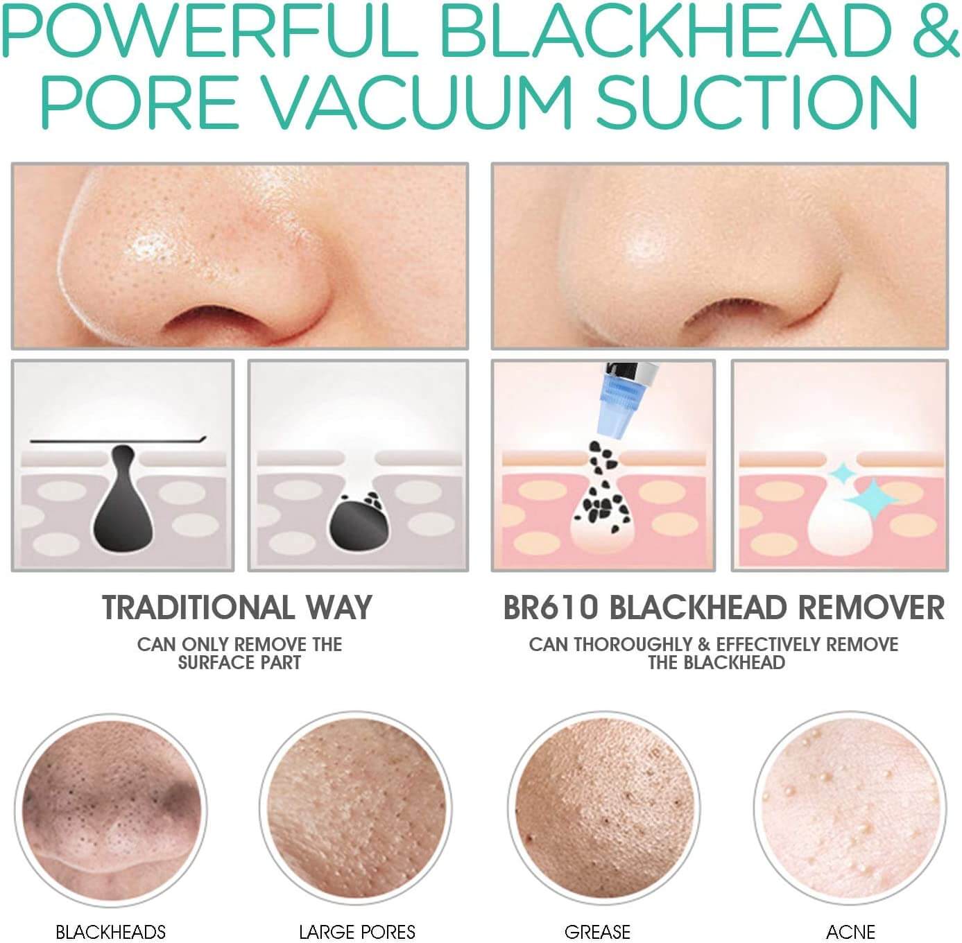 Blackhead Remover Vacuum Pore Cleaner Acne Comedone Extractor Tool Machine Ultra Strong Suction