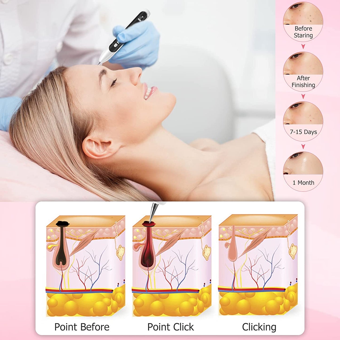 Mole Removal Sweep Spot Pen Plasma Pen Removal Skin Tag Tattoo Mole