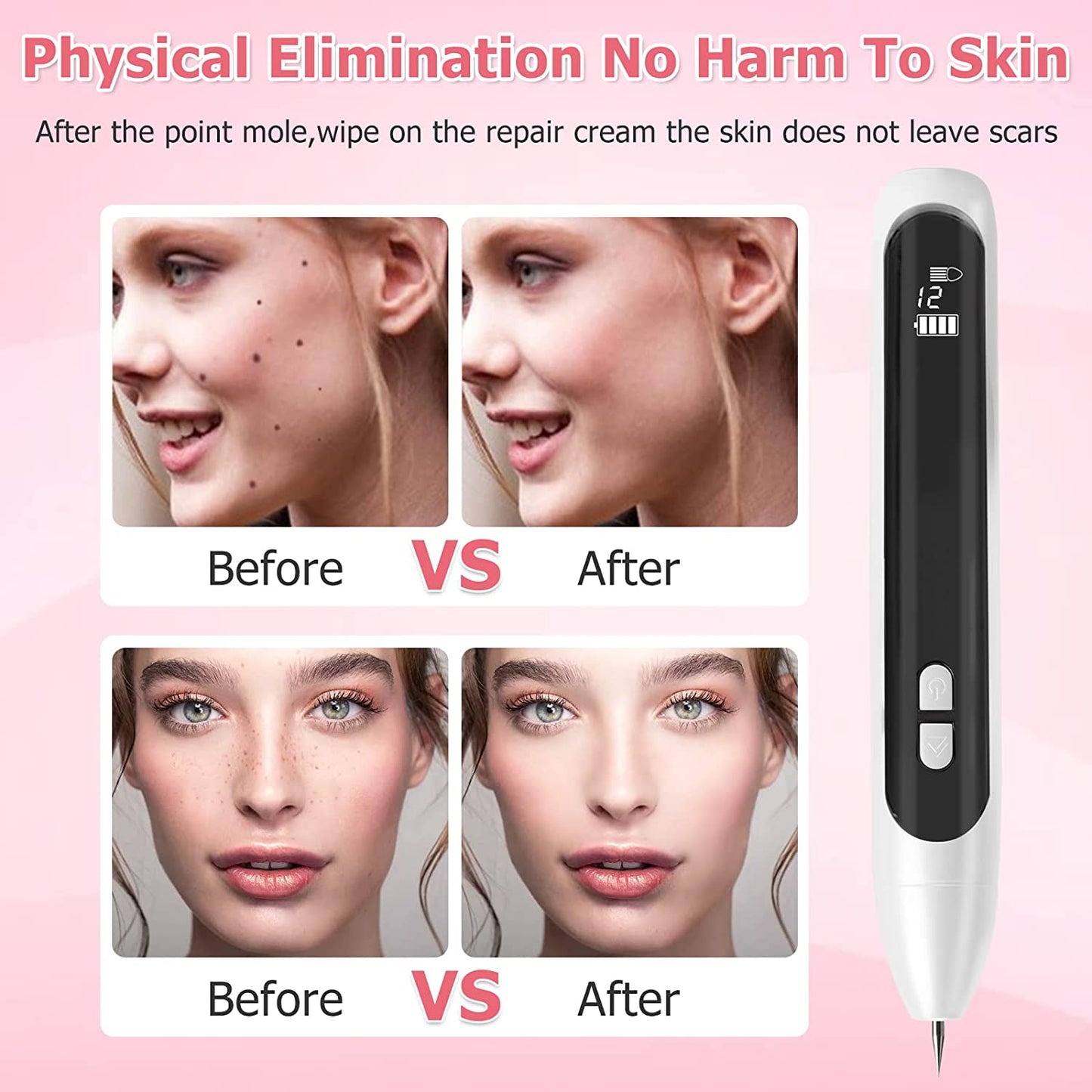 Mole Removal Sweep Spot Pen Plasma Pen Removal Skin Tag Tattoo Mole