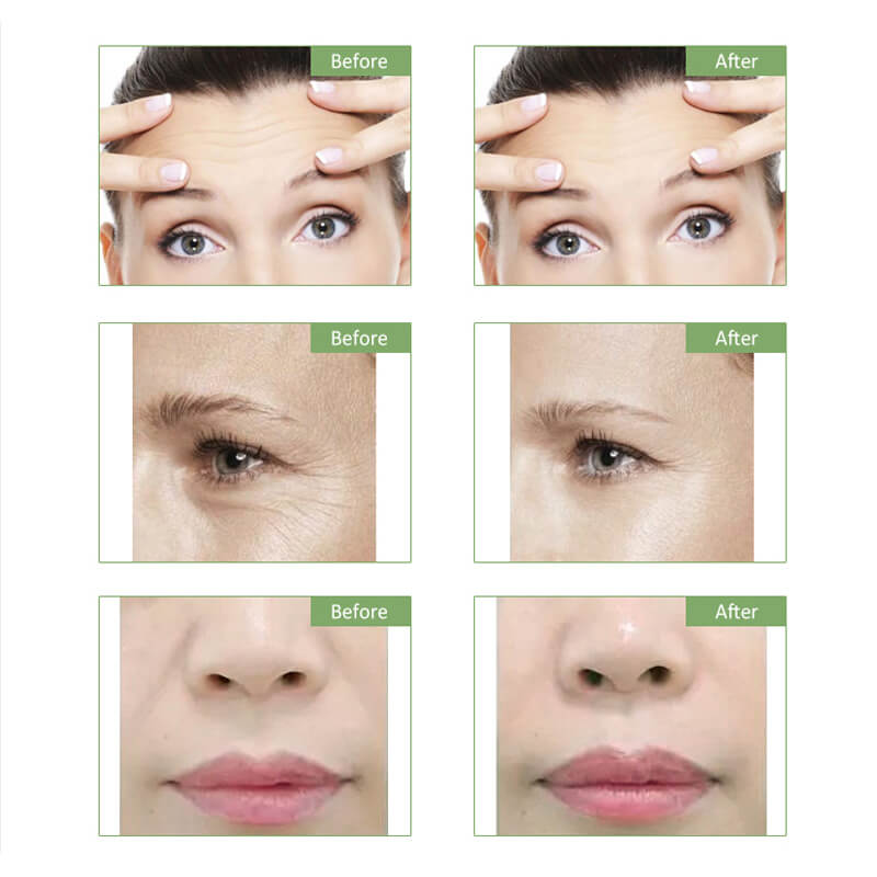 Radio Frequency Infrared Dot Matrix Lifting Facial Lifting Machine Anti Aging