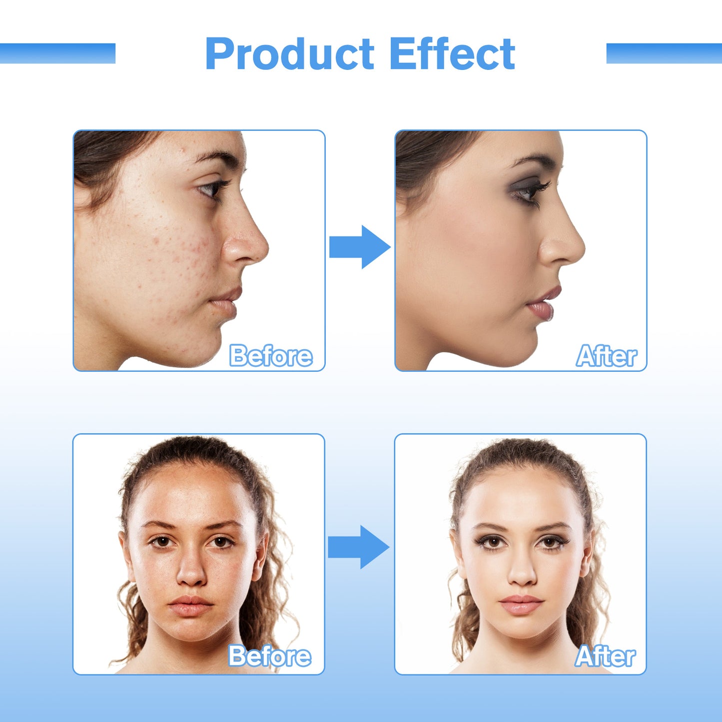 Skin Tightening Machine for Anti Aging
