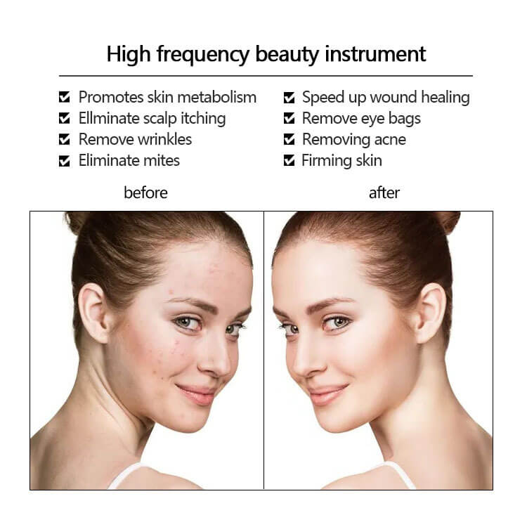 High Frequency Wand Neon & Argon Skin Therapy Machine Beauty Defect Repair Acne Treatment